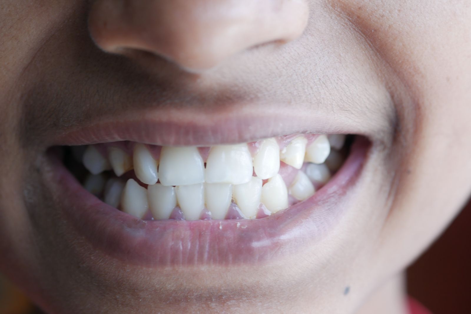 Close-up of a person's smiling mouth and teeth, no other identifying facial features visible